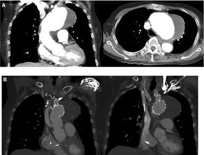 Case report: Total arch replacement with a frozen elephant trunk utilizing open hybrid in-situ fenestration technique for thoracic aortic arch aneurysm